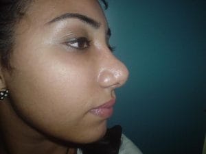 Big boxy nose after correction Big Nose boxy Nose Tip Definition Rhinoplasty at Best Plastic Surgery Egypt after