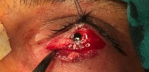 Silicon in Eyelids Best Plastic Eyelid Surgery for Silicon removal from This 42 year old man