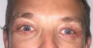 After Blepharoplasty Blepharoplasty Eyelid Surgery in Best Cosmetic Surgery in Egypt Nile Cosmetic Center After