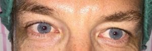 Before Blepharoplasty Blepharoplasty Eyelid Surgery in Best Cosmetic Surgery in Egypt Nile Cosmetic Center Before