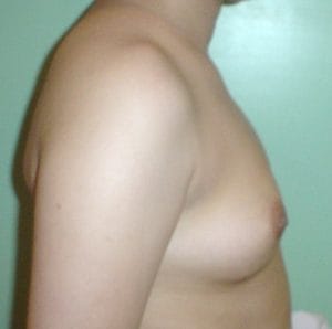 Breast Enlargement using Silicon Implant at Best Plastic Surgery in Egypt Before Side view