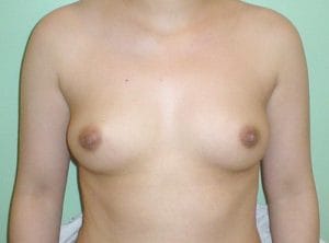 Breast Augmentation using Silicon Implant at Best Plastic Surgery in Egypt Before