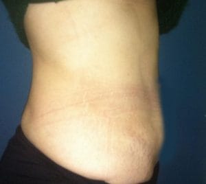 Restored waist by Vaser High Definition 4D Liposculpture at Best Cosmetic Surgery Egypt after side view