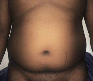 Melon tummy 4D Vaser Smart Liposuction at Best Plastic Surgery in Egypt, before