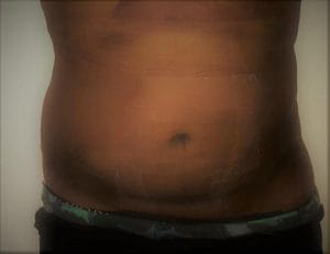 Melon tummy 4D Liposuction at Best Plastic Surgery in Egypt, after