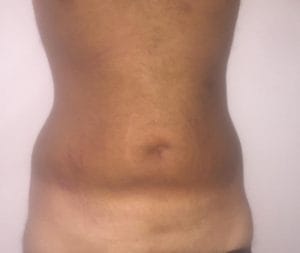 Tummy Love Handle Vaser High Definition 4D Liposuction and Liposculpture at Best Cosmetic Surgery in Egypt after