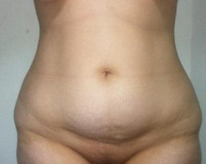 Restored waist by Vaser High Definition 4D Liposculpture at Best Cosmetic Surgery Egypt before