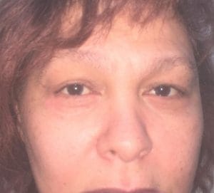 Lower eyelid surgery and suspension before Before Best Cosmetic Surgery baggy lower eyelids fine wrinkles. A lower blepharoplasty with eyelid lift and suspension