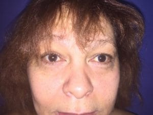 Lower Eyelid surgery after After baggy lower eyelids fine wrinkles. A lower blepharoplasty with eyelid lift and suspension at Best aesthetic Surgery