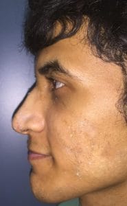 Hump correction after Best Cosmetic Plastic Surgery in Egypt Big Nose with Hump after