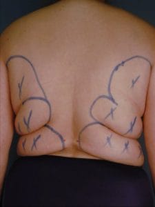 Before back and bra-line liposuction Best Plastic Surgery in Egypt, Back and Bra-Line Vaser Liposuction, High Definition Liposuction, 4 Dimensional Liposuction, Smart HD 4D Liposuction, Before