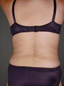 after back vaser liposuction and bra-line Best Plastic Surgery in Egypt, Back and Bra-Line Vaser Liposuction, High Definition Liposuction, 4 Dimensional Liposuction, Smart HD 4D Liposuction, after