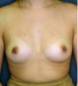 Breast Enlargement Fat Injection grafting Negative Expansion Best Cosmetic Surgery Egypt Before