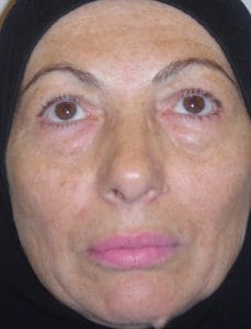 After Face Lift and Blepharoplasty After skin sagging and baggy eyelids and desired contouring of her eyelids and face. A full face rejuvenation and eyelid surgery at Best Plastic Cosmetic Surgery Egypt