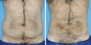 Flattened Love Handle Vaser High Definition 4D Liposuction and Liposculpture at Best Aesthetic Plastic Surgery in Egypt