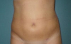 Hourglass contour in Lower Abdomen Vaser High Definition 4D Liposuction at Best Plastic Surgery in Egypt After