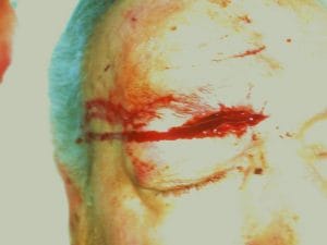 Best Aesthetic Surgery Egypt, Best Cosmetic Surgery Egypt, Scar Cosmetic Surgery for a deep eyebrow wound of the face, photo before