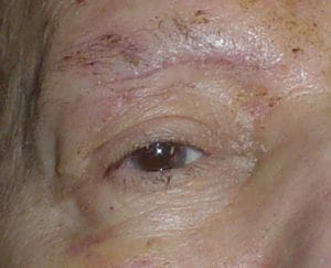 Best Aesthetic Surgery Egypt, Best Cosmetic Surgery Egypt, Scar Cosmetic Surgery for a deep eyebrow wound of the face, photo after