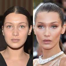 Best Plastic Surgery in Egypt, Mid cheek fat removal to get more definition of the face and better contour