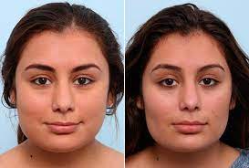 Best Plastic Surgery in Egypt, Mid cheek Buccal fat removal to get more definition of the face and better contour