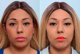 Buccal fat Removal for thinner face at Best Plastic Surgery in Egypt and Best Cosmetic Surgery Egypt.