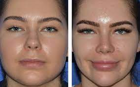 Best Cosmetic Surgery in Egypt, Mid cheek Buccal fat removal to get more definition of the face and better contour of the cheek and jawline.