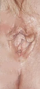 Best Plastic Aesthetic Surgery Egypt Vulvoplasty, Labiaplasty, Designer Vaginal Tightening, and clitoris hood shaping, photo before