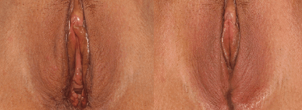 Best Cosmetic Surgery Egypt, Clitoral hood excision and Vaginal tightening by muscle repair