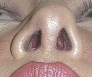 Deviated-nose- Nose Job Rhinoplasty, Secondary Nose Job, Nose Tip, Nose Hump, Big Boxy Nose, Best Plastic Surgery Egypt, Best Cosmetic Surgery Egypt