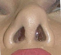Deviated-nose- Nose Job Rhinoplasty, Secondary Nose Job, Nose Tip, Nose Hump, Big Boxy Nose, Best Plastic Surgery Egypt, Best Cosmetic Surgery Egypt