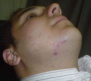 Best Aesthetic Surgery Egypt, Scar Plastic Surgery and Botox for a deep lacerated chin and jawline wound of the face, photo after