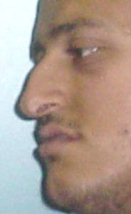 Before Hump Reduction Big Nose Hump Rhinoplasty at Best Plastic Surgery Egypt before