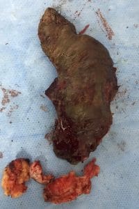 Keloid Eradication at the side of the face, Keloid removal, Scar treatment, removed keloid