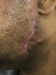 Keloid Eradication at the side of the face, Keloid removal, Scar treatment, photo after