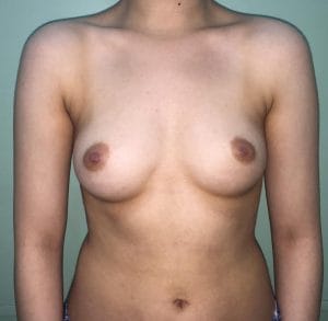 Cohesive Silicon Breast Enlargement Breast Lift Breast Augmentation Best Aesthetic Cosmetic Surgery Egypt Before