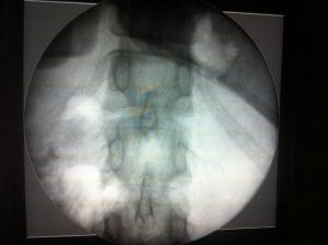 Sleeve Gastrectomy radiology, Best Cosmetic Surgery, Nile Cosmetic Center, Weight Loss Surgery