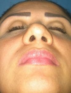 Rhinoplasty Inferior View after Big Boxy Hump After Inferior View Nose Job Rhinoplasty,Hump Boxy Big Nose, Best Cosmetic Surgery Egypt