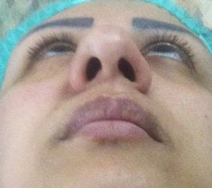 Before Big Boxy Hump Nose Inferior View Before Inferior View Nose Job Rhinoplasty,Hump Boxy Big Nose, Best Cosmetic Surgery Egypt