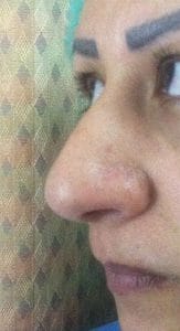 Big Hump Boxy Nose Before Before Nose Job Rhinoplasty,Hump Boxy Big Nose, Best Cosmetic Surgery Egypt