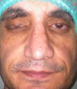 Big Broad Nose Before Nose Job Rhinoplasty, Nose Tip, Broad deviated Nose, Big Boxy Nose, Best Aesthetic Surgery Egypt, Best Cosmetic Surgery Egypt