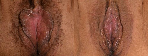 Best Cosmetic Surgery Egypt, G spot Injection Vulvoplasty, Vaginoplasty, Labiaplasty and Designer Vaginal Tightening for wide patulous vagina after repeated chilbirth