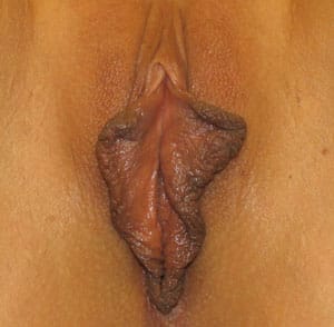 Best Cosmetic Surgery Egypt, G spot Injection and huge labia trimmed attaining a Vulvoplasty, and aesthetic Labiaplasty, and also Designer Vaginal Tightening, photo before