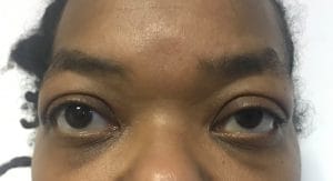 Ptosis and Eyelid Decompression after Best Cosmetic Surgery in Egypt for Upper Blepharoplasty and upper eyelid surgery with Lower blepharoplasty and orbital decompression and ptosis treatment.
