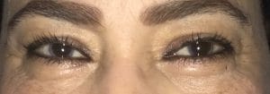 Blepharoplasty Eyelid Surgery Before Best Plastic Surgery in egypt for Tear Trough Deformity in Eyelid Surgery and Blepharoplasty