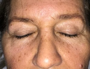 Upper Blepharoplasty Eyelid lift (1) Upper Blepharoplasty Eyelid Surgery to remove saggy overhanging skin at Best Plastic Surgery in Egypt