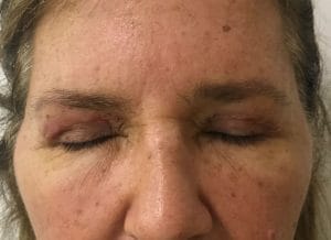 Upper Blepharoplasty Eyelid lift (2) Upper Blepharoplasty Eyelid Surgery to remove saggy overhanging skin at Best Cosmetic Surgery in Egypt