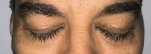 Upper blepharoplasty upper eyelid surgery (1) Sagging upper eyelids, Upper eyelid blepharoplasty, Best Plastic Surgery in Egypt, Baggy Eyelids