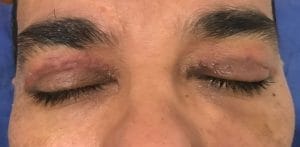 Upper blepharoplasty upper eyelid surgery (2) Sagging upper eyelids, Upper eyelid blepharoplasty, Best Cosmetic Surgery in Egypt, Baggy Eyelids