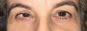 Eyelid Bleph (1) Baggy Eyelids and Wrinkles in Eyelids treated by Transcutaneous Blepharoplasty at Best Cosmetic Surgery in Egypt