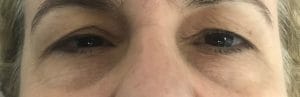 Eyelid Bleph (2) Baggy Eyelids and Wrinkles in Eyelids treated by Transcutaneous Blepharoplasty at Best Plastic Surgery in Egypt